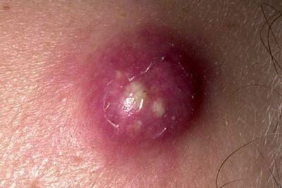 癤の治療について〜毛穴に一致した発赤・硬結・痛み・排膿をみたらそれは「癤(せつ)」かもしれません〜