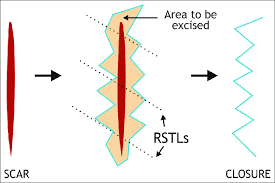 W形成術とは？顔の傷跡を目立たなくする仕組み