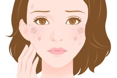 肝斑の疫学・原因・治療を完全解説2026年版