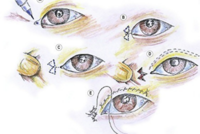 目頭切開の違いを徹底比較｜Z法・W法・リドレープ法