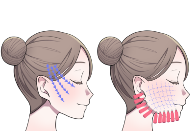 ショッピングリフトとは？効果・副作用を美容外科専門医が解説