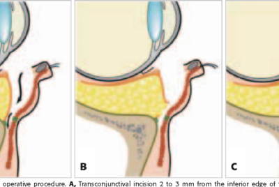 裏ハムラのダウンタイム真実｜腫れのピークはいつ