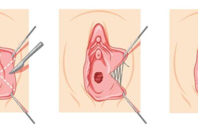 形成外科専門医解説：小陰唇縮小を後悔しないための真実