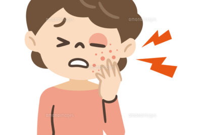 帯状疱疹で目が赤い？眼科が教える帯状疱疹眼症状の対処法