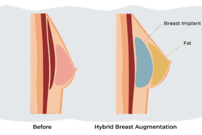 ハイブリッド豊胸とは？メリットと欠点を徹底比較