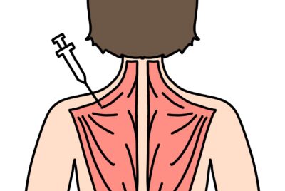 肩ボトックス完全ガイド｜効果・副作用・料金など