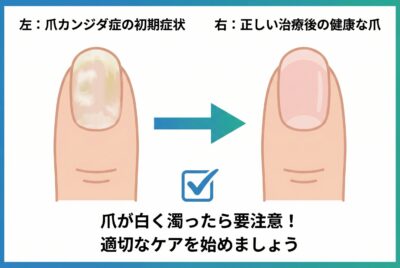【医師監修】爪の白濁はカンジダ？症状と見分け方【写真付き】