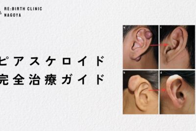 【医師監修】ピアスケロイドの最新治療法まとめ