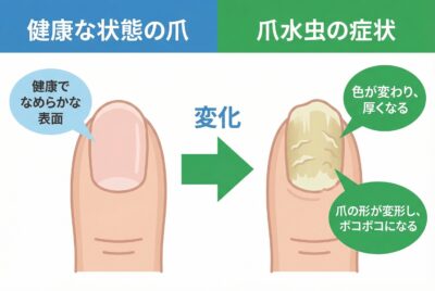 【皮膚科医が教える】爪水虫（爪白癬）の種類、症状、治療、薬について【完全ガイド】