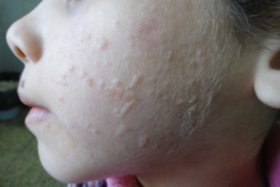 「うつる？」写真で見る扁平疣贅、感染リスクは？治療法は？