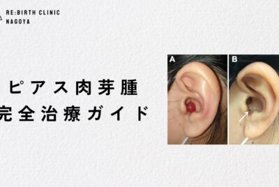 【形成外科専門医監修】ピアス肉芽腫の正しい治療ガイド