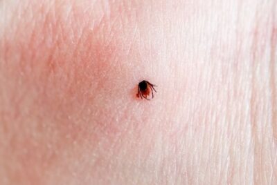 マダニに刺された後の症状チェックリスト（写真あり）