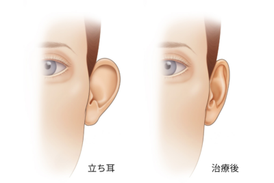 立ち耳の治し方完全ガイド【形成外科専門医監修】