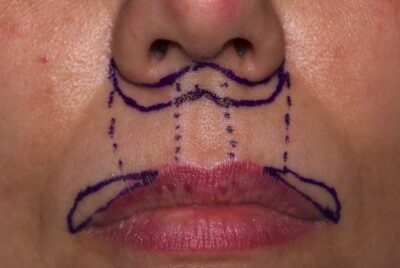 外側人中短縮で作る自然な口元の完成ガイド