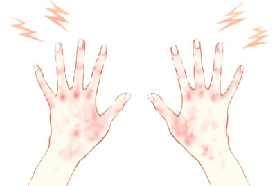 皮膚科医が教える：ストレス起因の手湿疹の正しい治療法