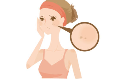 【皮膚科医が解説】戻りジミの経過とピークはいつ？ひどい時の対処法