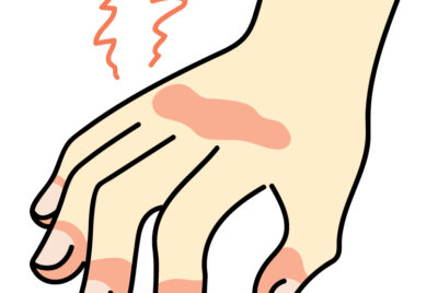 【形成外科専門医監修】エクラープラスターの効果と副作用、使い方・貼り方完全ガイド