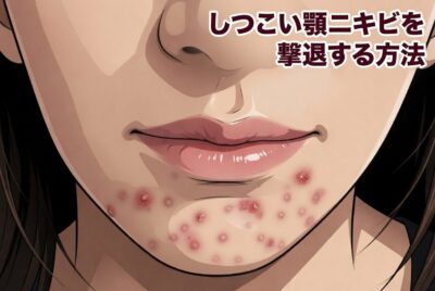 【皮膚科医監修】頑固なあごのしこりニキビと最新治療法