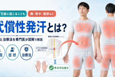 代償性発汗とは?原因と治療法を専門医が図解で解説
