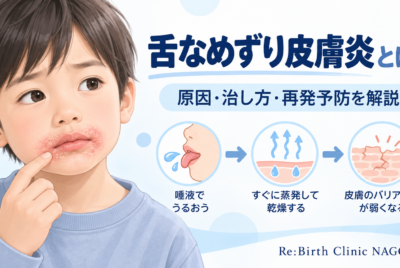 舌なめずり皮膚炎(なめまわし皮膚炎、口なめ病)とは 〜原因 治し方 薬を皮膚科医が解説〜